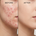 SalSphere® Benzoyl Peroxide (BPO)