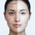 Before and after comparison of a woman's face with visible skin improvement to whitening.