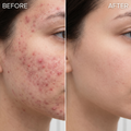 Before and after comparison of a person's face with acne on the left and clear skin on the right.