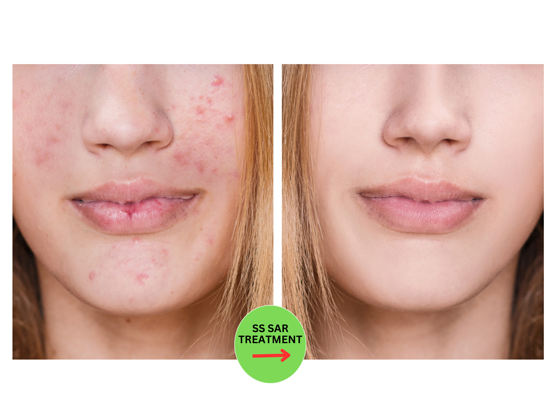 SalSphere® Severe Acne Relief