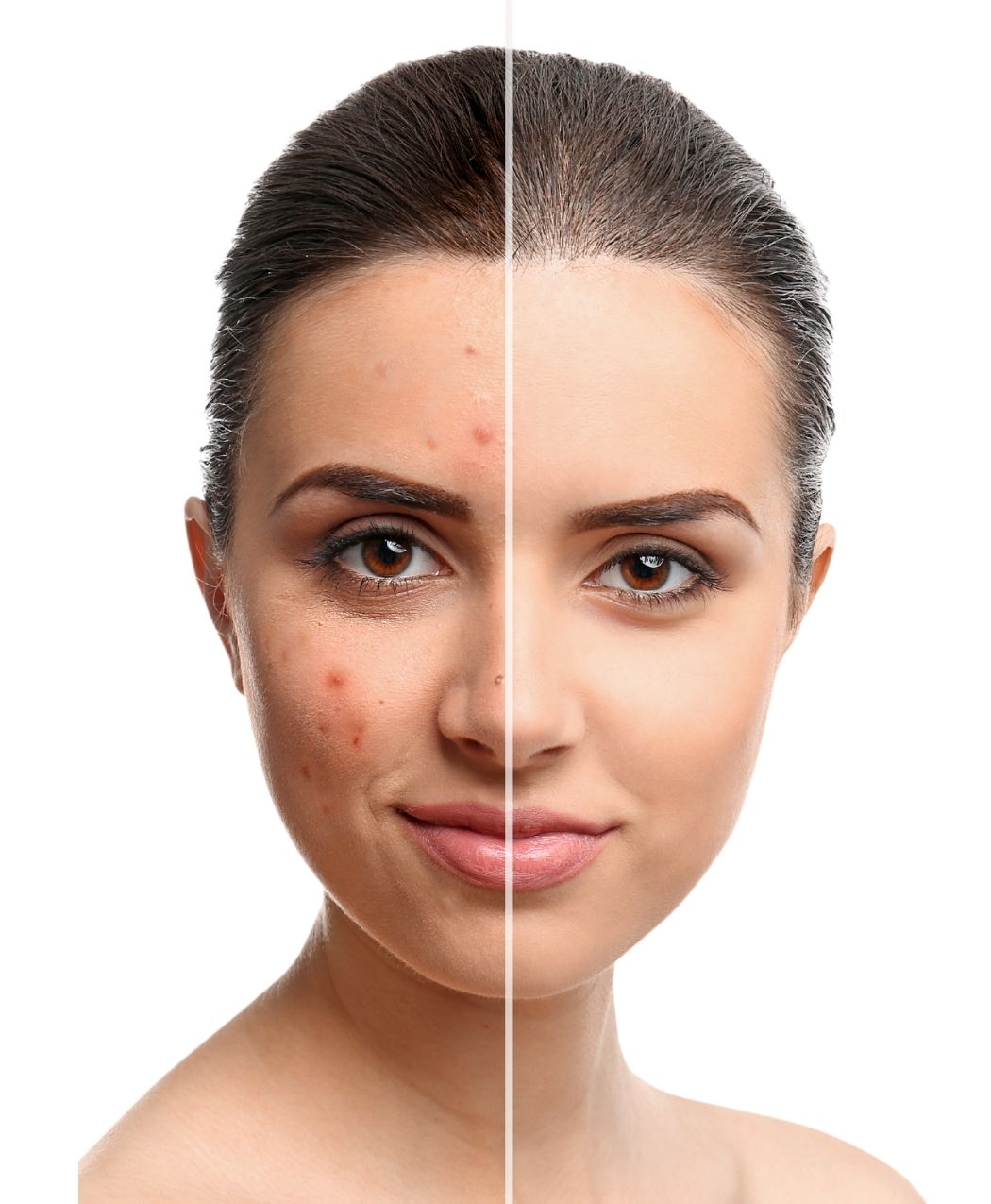 SalSphere® Severe Acne Relief